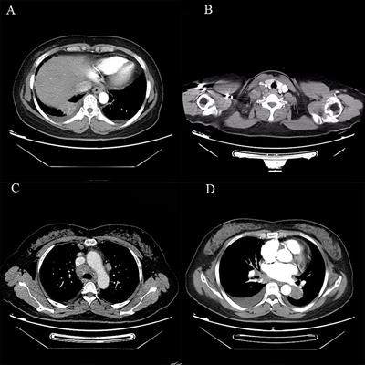 Multiple Primary Lung Cancers With ALK Rearrangement: A Case Report and Literature Review